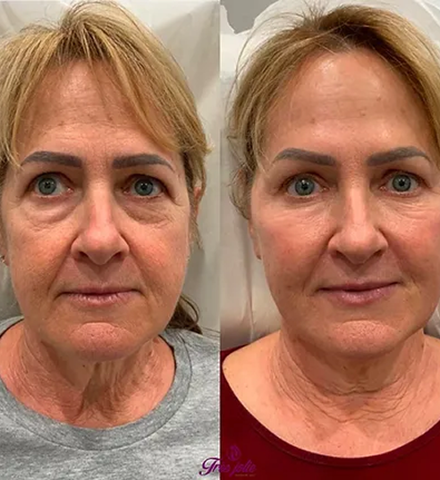 Full Face Treatment