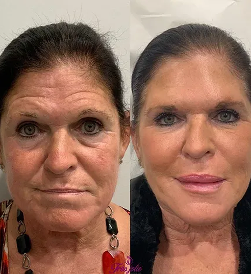 Full Face Treatment