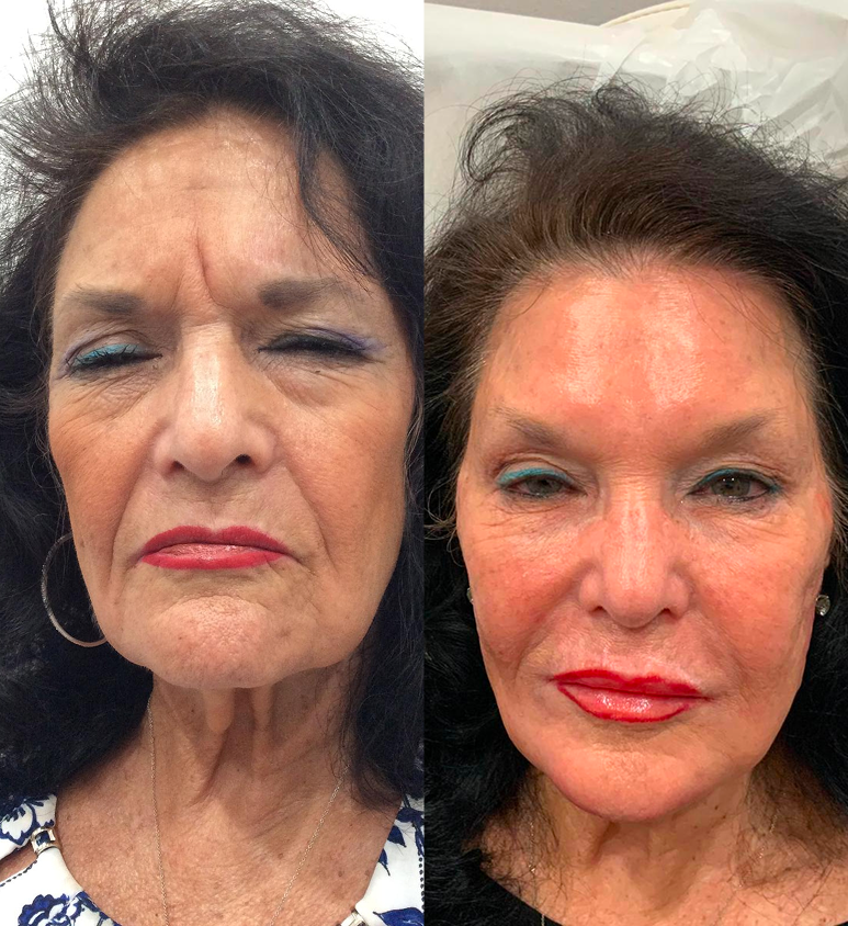 Full Face Treatment