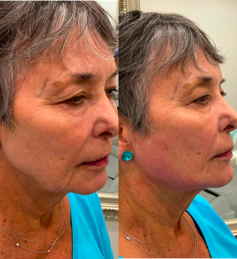 Jawline Filler