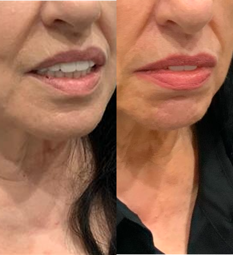 Jawline Filler