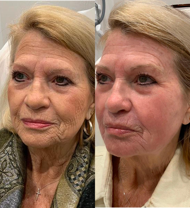 Co2 Laser Resurfacing