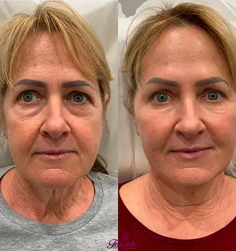 Full Face Treatment