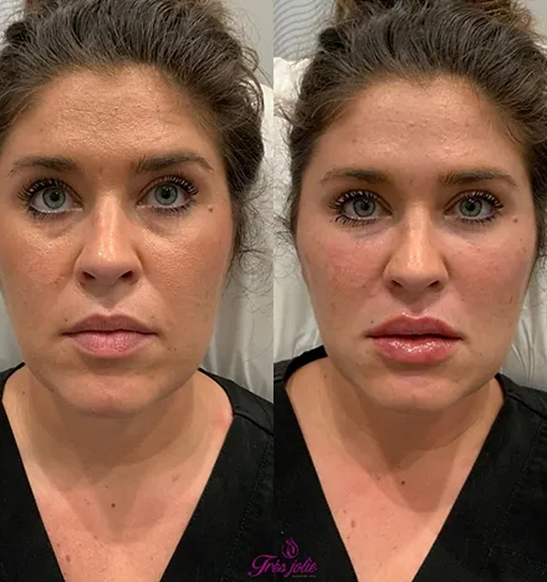 Full Face Treatment