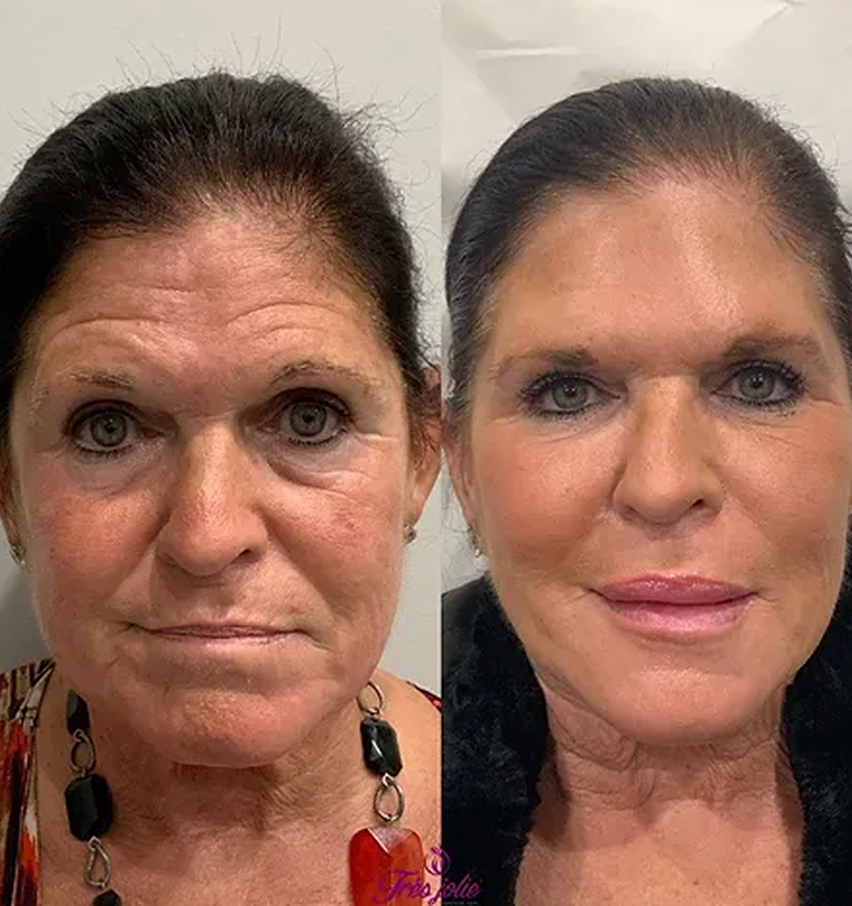 Full Face Treatment