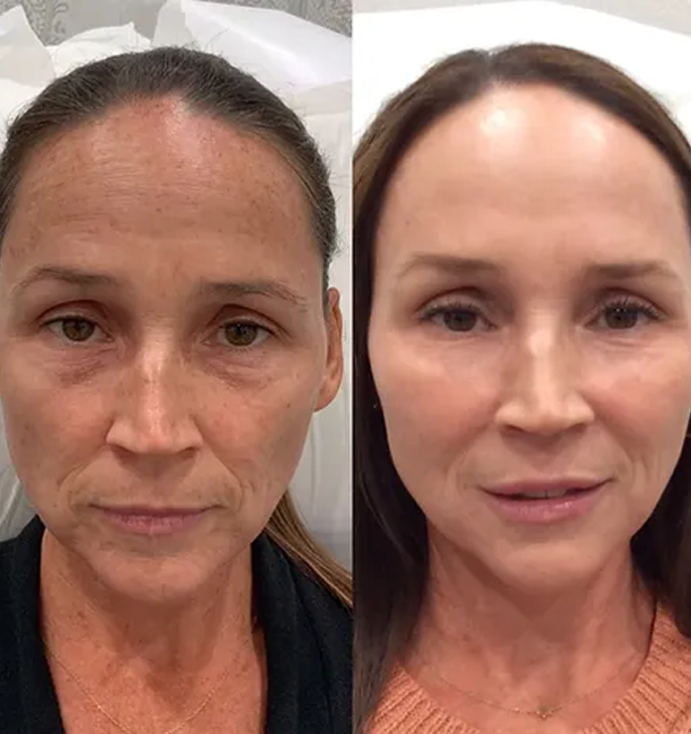Full Face Treatment