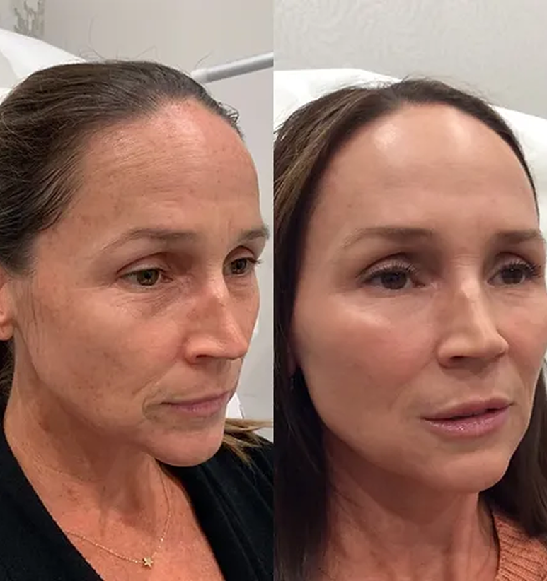 Full Face Treatment