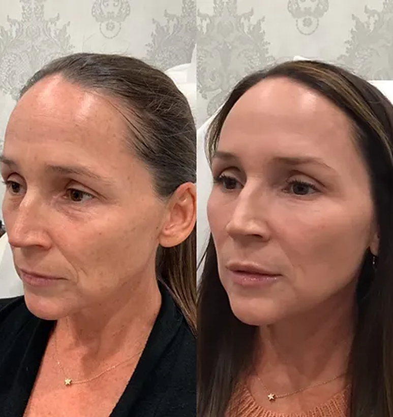 Full Face Treatment