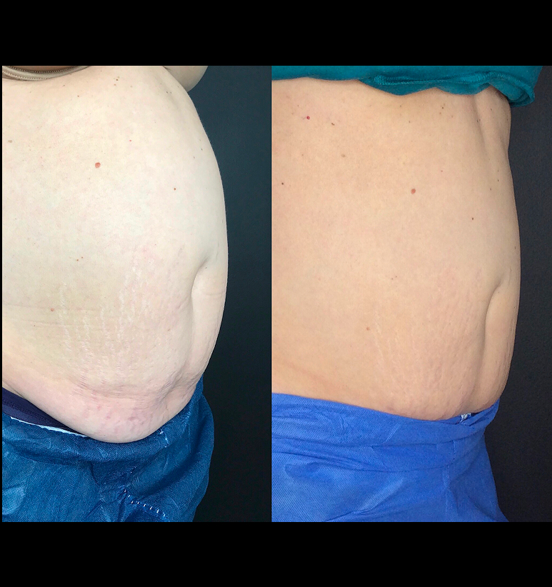 Coolsculpting