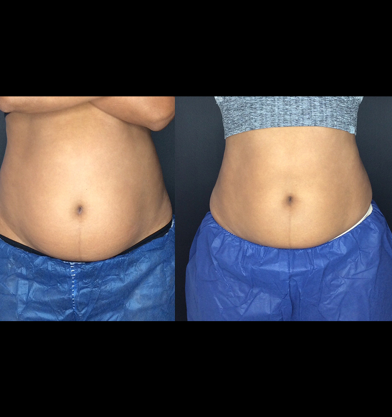 Coolsculpting