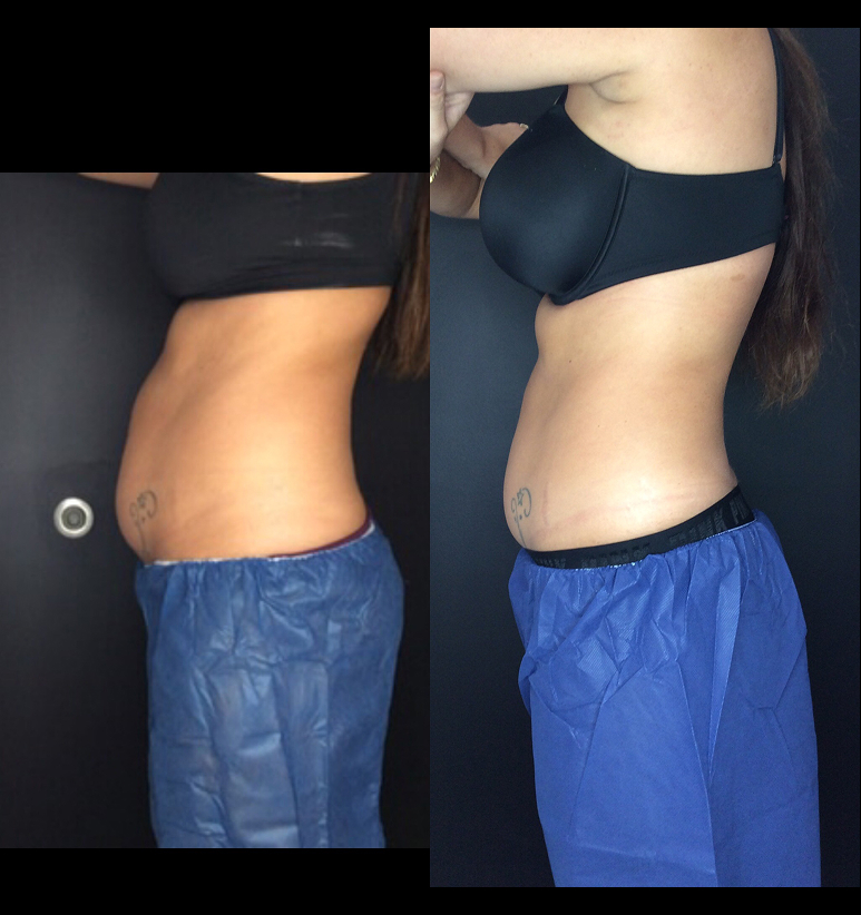 Coolsculpting