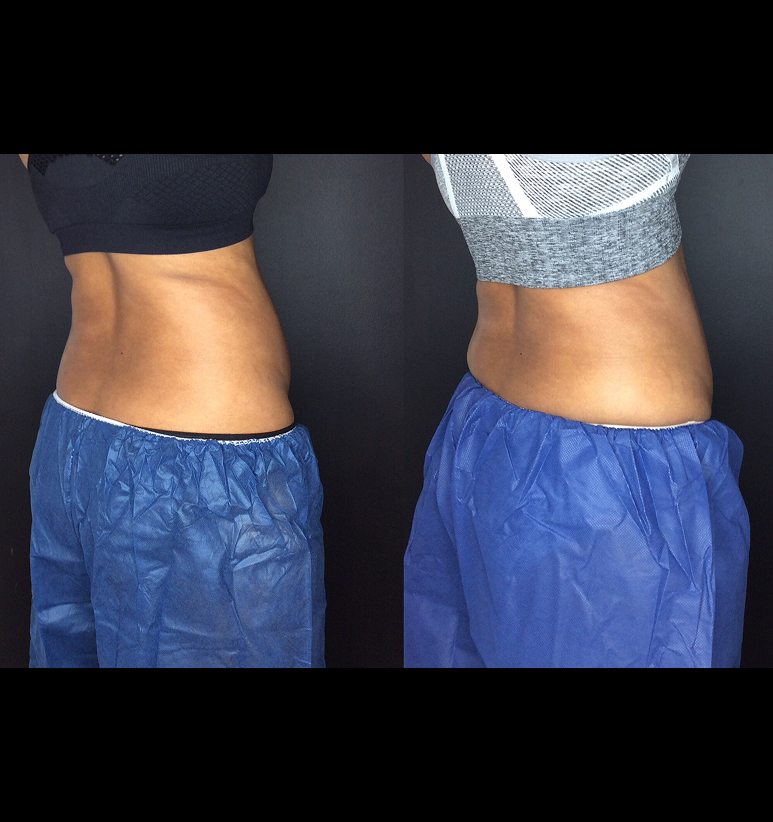 Coolsculpting
