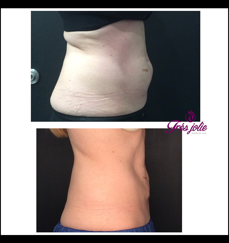 Coolsculpting