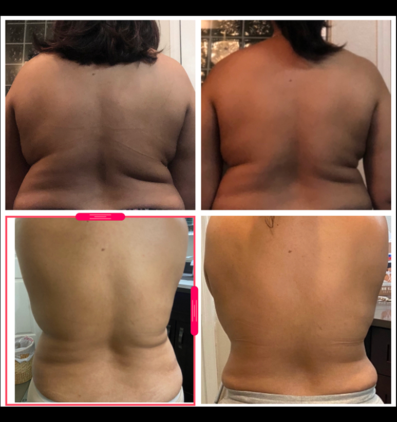 Coolsculpting