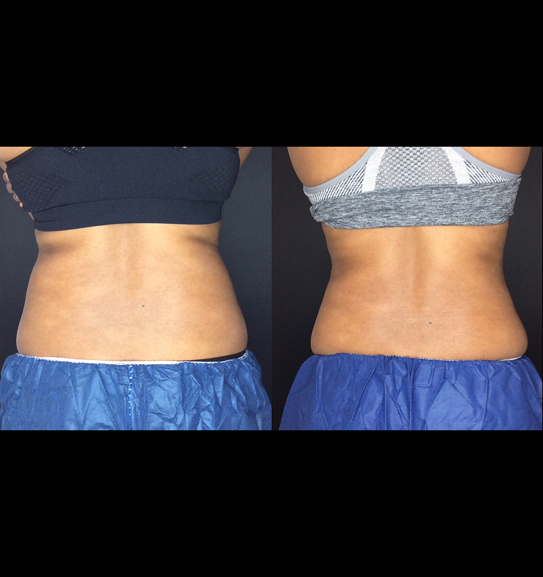 Coolsculpting