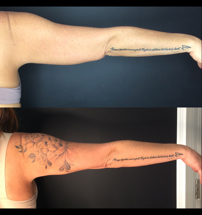 Coolsculpting