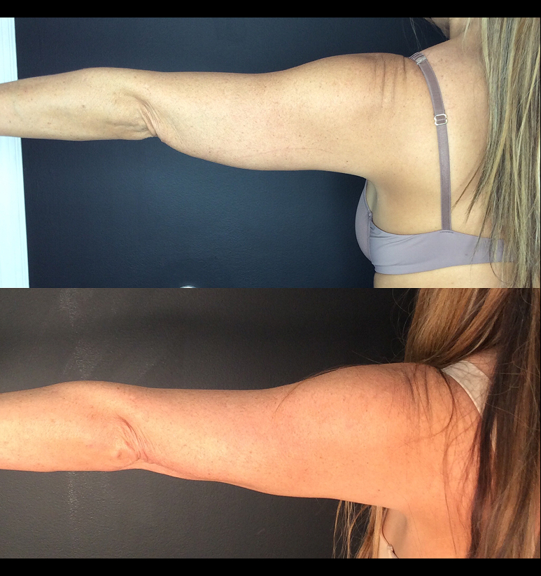 Coolsculpting