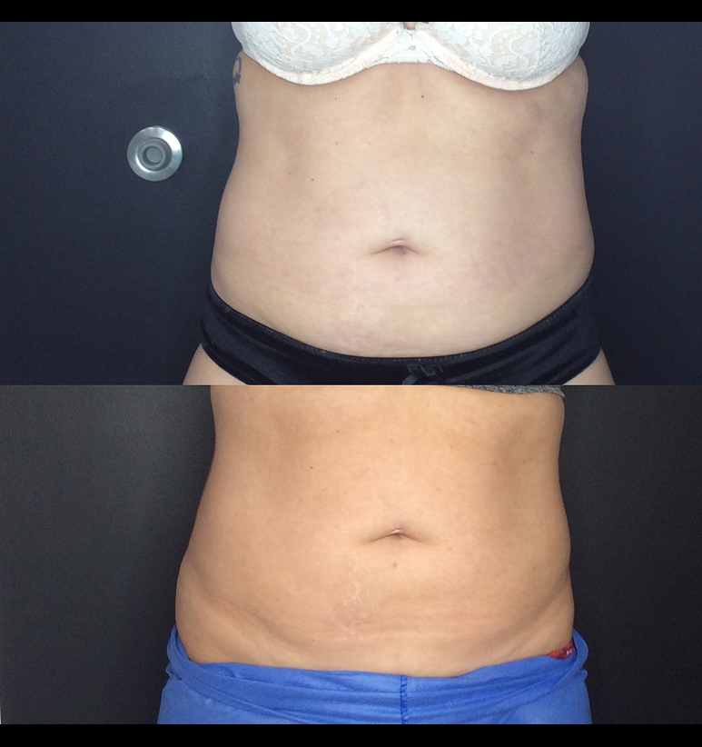 Coolsculpting