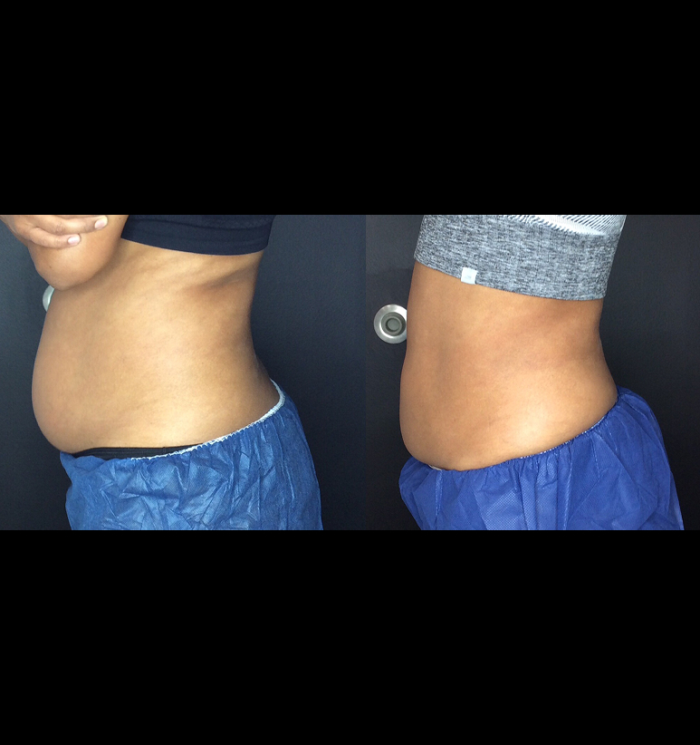 Coolsculpting