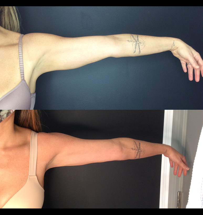 Coolsculpting