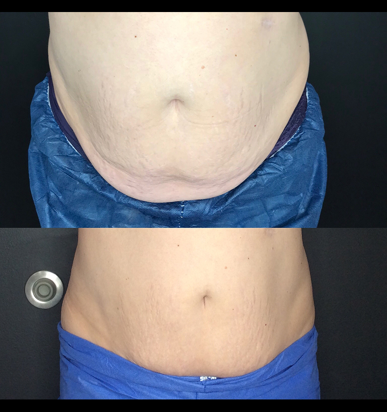 Coolsculpting