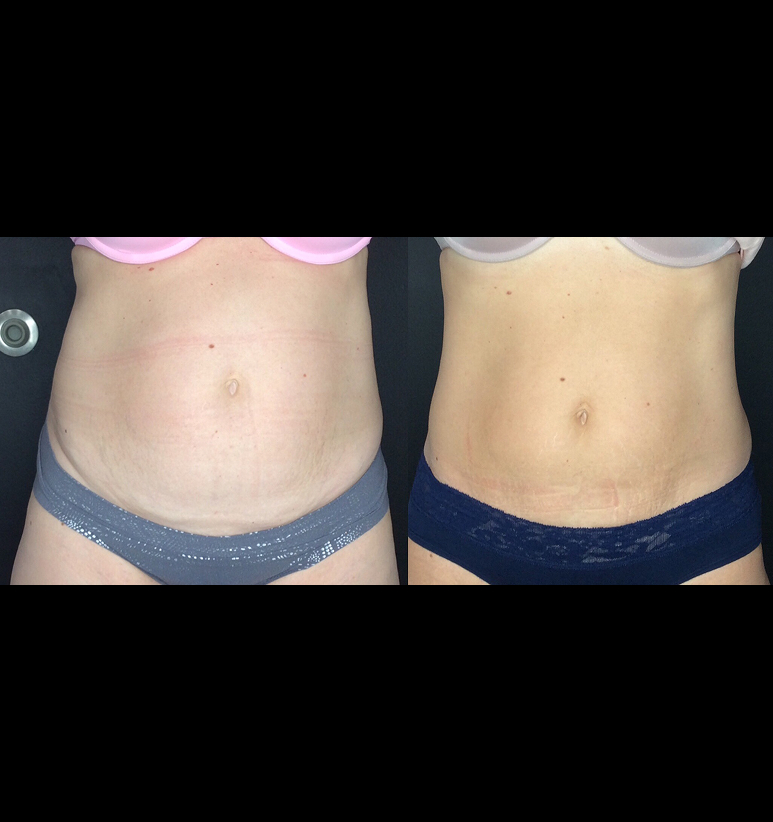 Coolsculpting