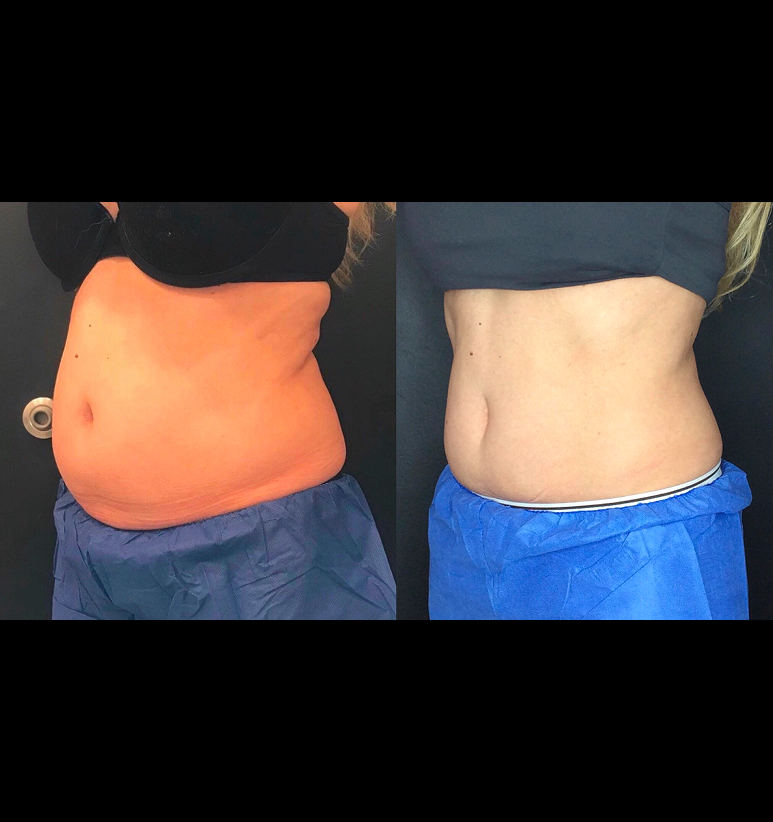 Coolsculpting