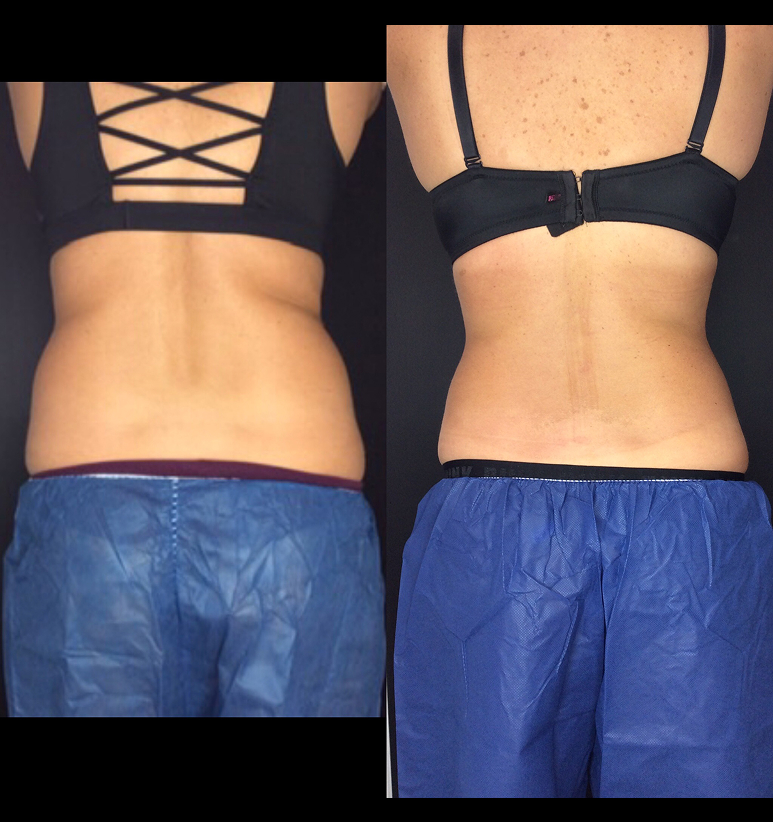 Coolsculpting