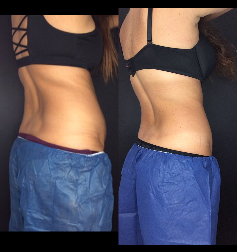 Coolsculpting