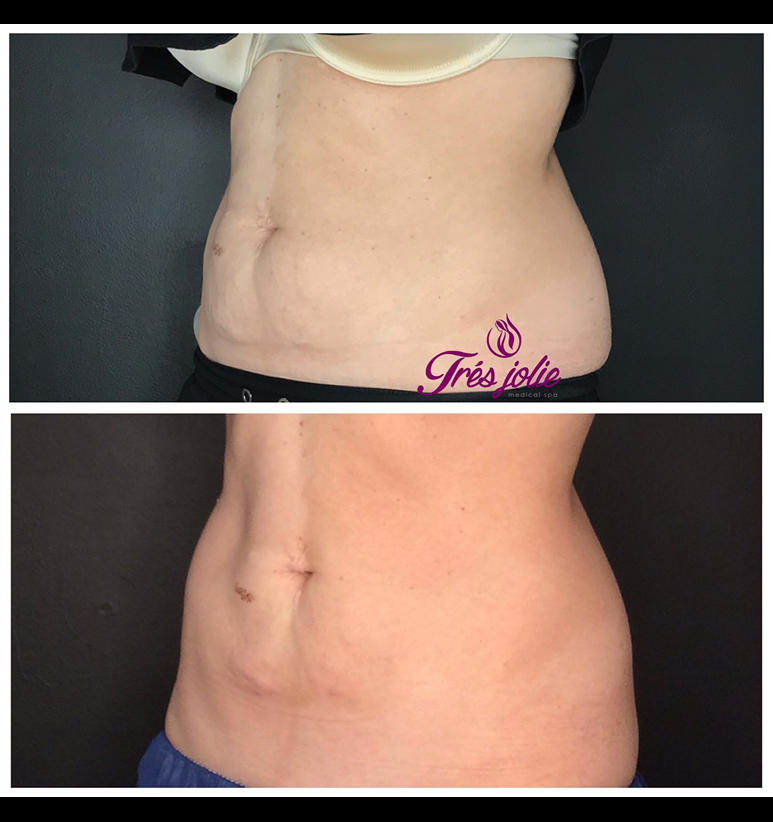 Coolsculpting