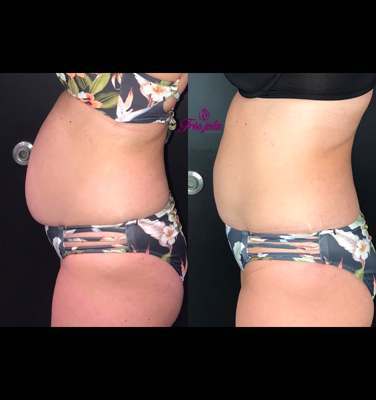 Coolsculpting