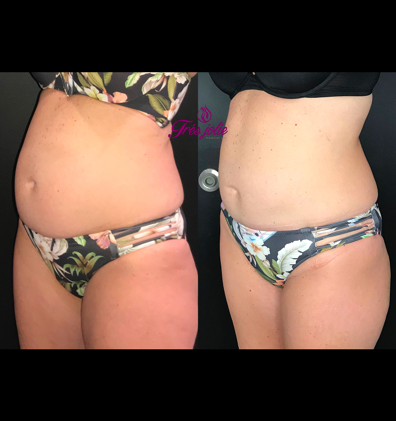 Coolsculpting