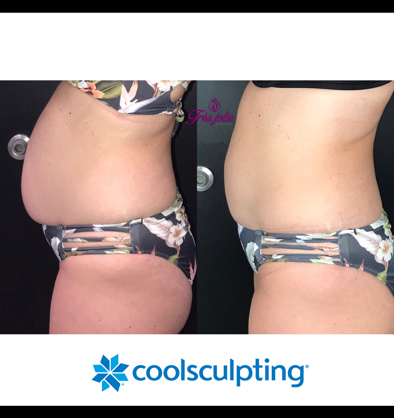 Coolsculpting