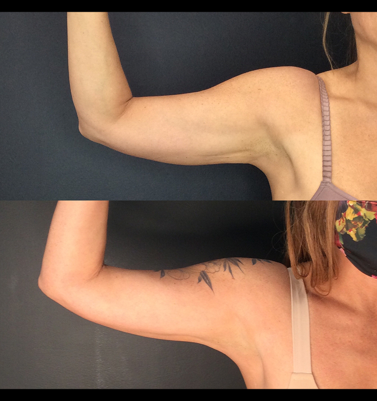 Coolsculpting