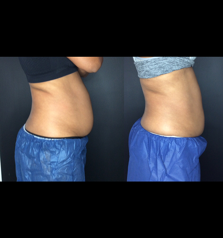 Coolsculpting