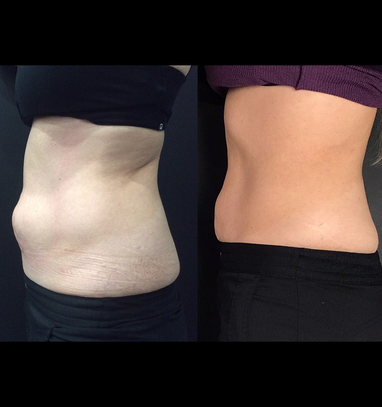 Coolsculpting