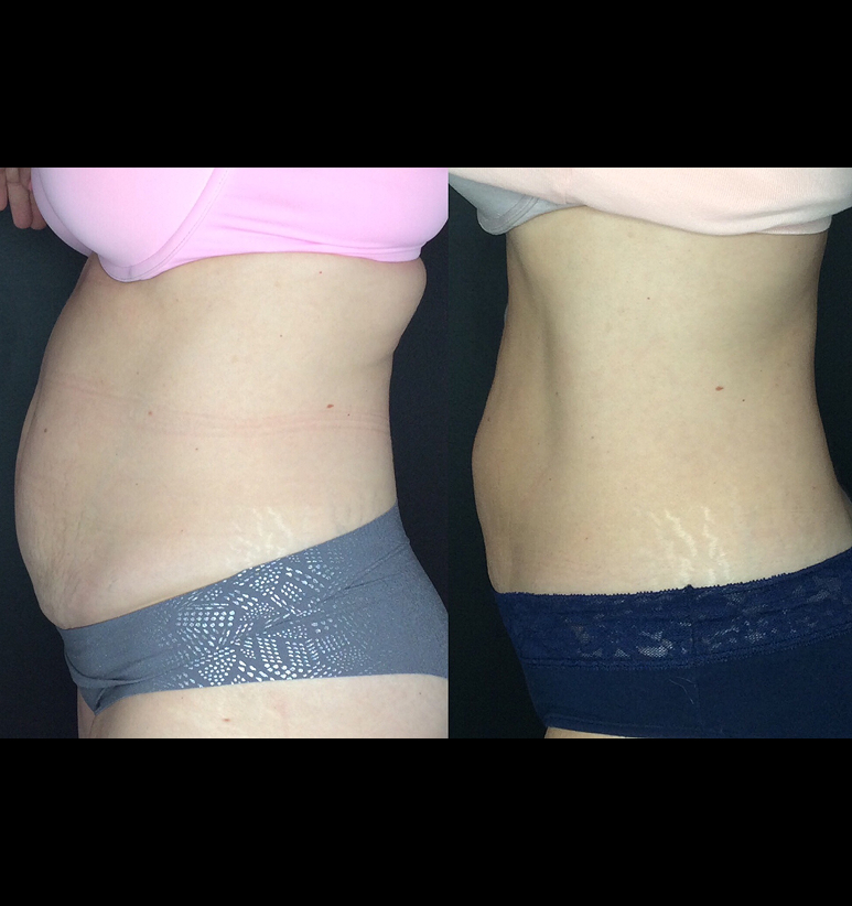 Coolsculpting