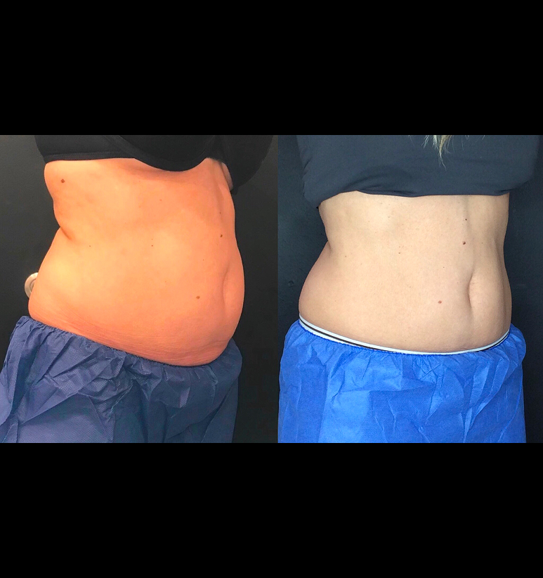 Coolsculpting
