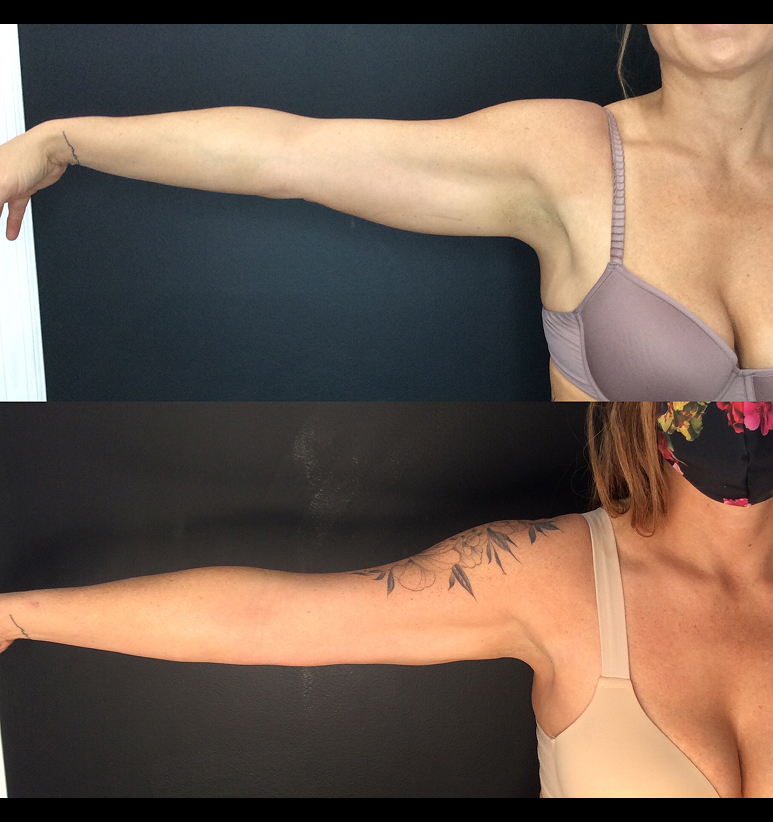 Coolsculpting