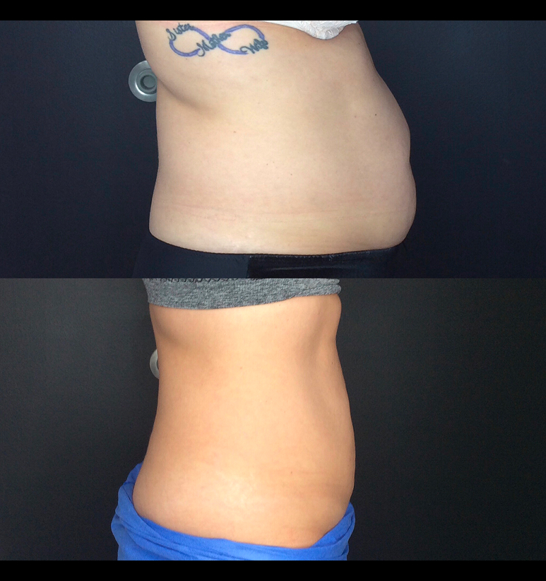 Coolsculpting