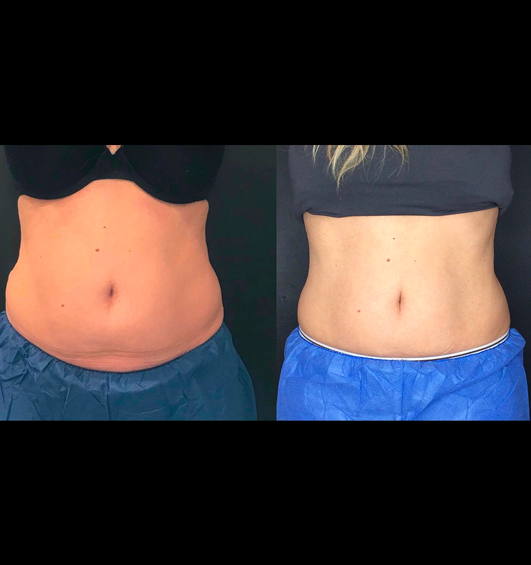 Coolsculpting