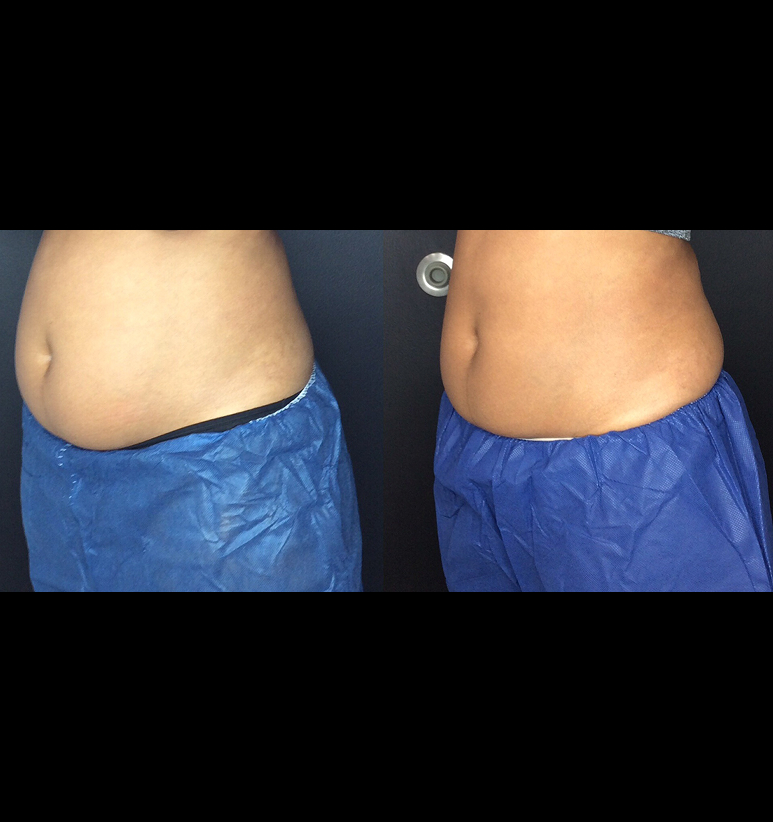 Coolsculpting