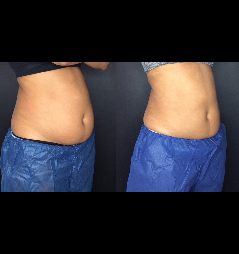 Coolsculpting