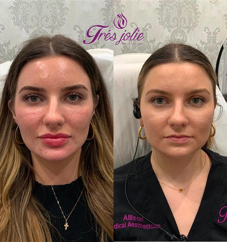 Chin Filler