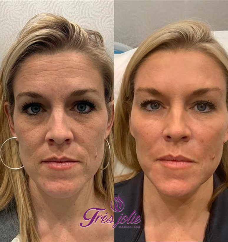 Sculptra and Dysport