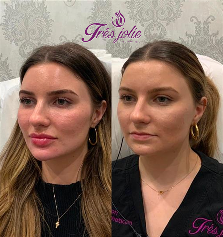 Chin Filler