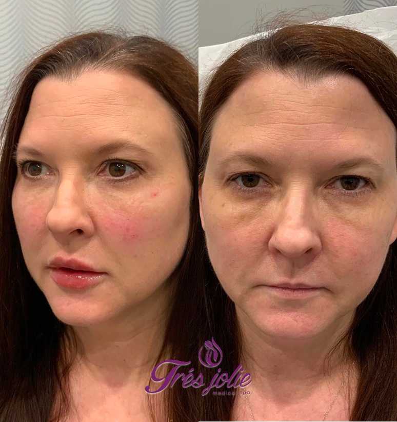 Undereyes