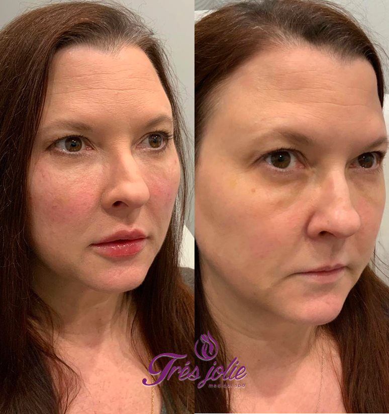 Undereyes