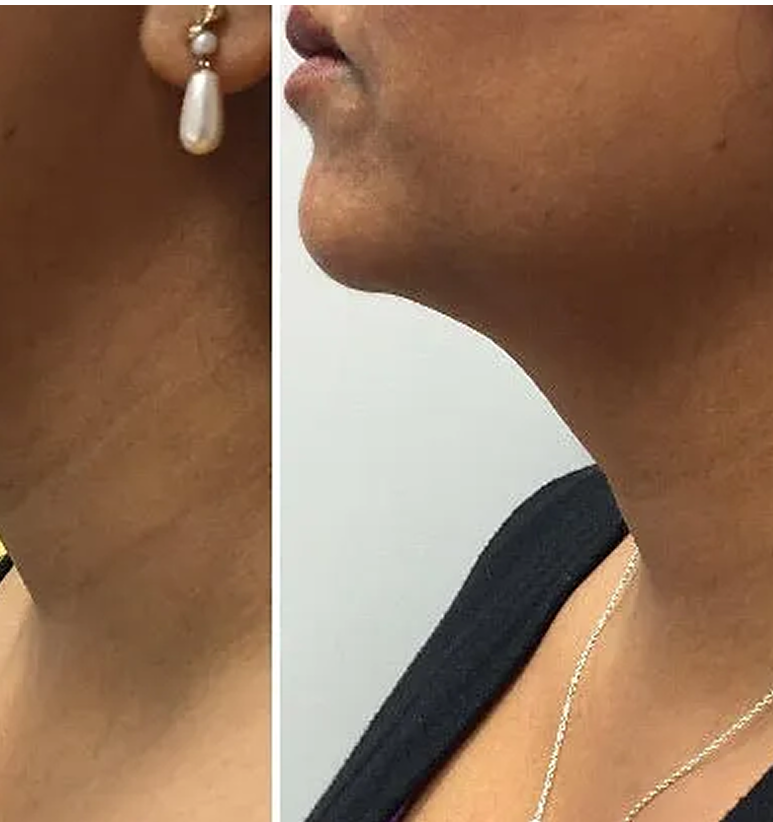 Kybella
