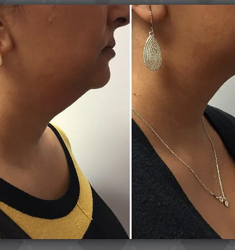 Kybella